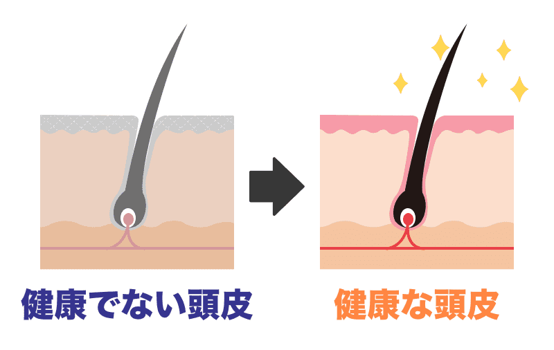 変更でない頭皮と健康な頭皮のイラスト